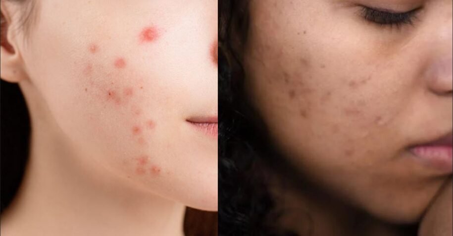 Acne Marks VS Acne Scars – What makes the two different?